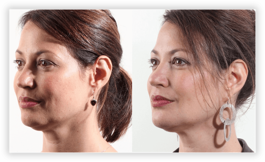 Non Surgical Facelift 2